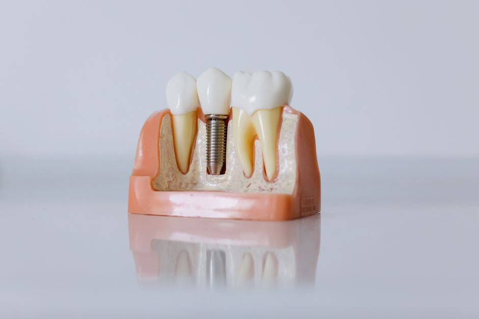 Zubni implantat